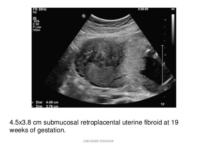 Cm Submucosal Retroplacental Uterine Fibroid At 19 Weeks Of Gestation Cm Submucosal Retroplacental Uterine Fibroid At 19 Weeks Of Gestation