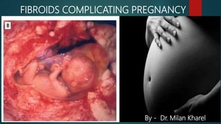 FIBROIDS COMPLICATING PREGNANCY
By - Dr. Milan Kharel
 