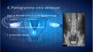 4. Pyelogramme intra veineuse
Dans le fibrome cervical ou du ligament large
• l’urtere
• hydrouretere ou hydronephrose
• la fonction renale
 