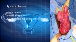 Hysterectomie
Fibrome cervival
Fibromes multiple
Saignement abondant durant une myomectomie
 