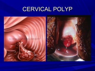CERVICAL POLYPCERVICAL POLYP
 