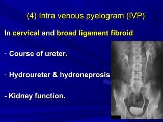 HysterectomyHysterectomy
Indication:Indication:
1)1)Multiple myomaMultiple myoma
2)2)Cervical fibroidCervical fibroid
3)3)...