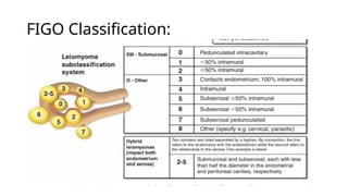 Comprehensive Overview of Uterine Fibroids: Diagnosis, Symptoms, and ...