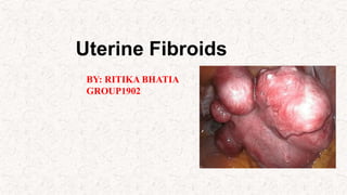 Uterine Fibroids
BY: RITIKA BHATIA
GROUP1902
 