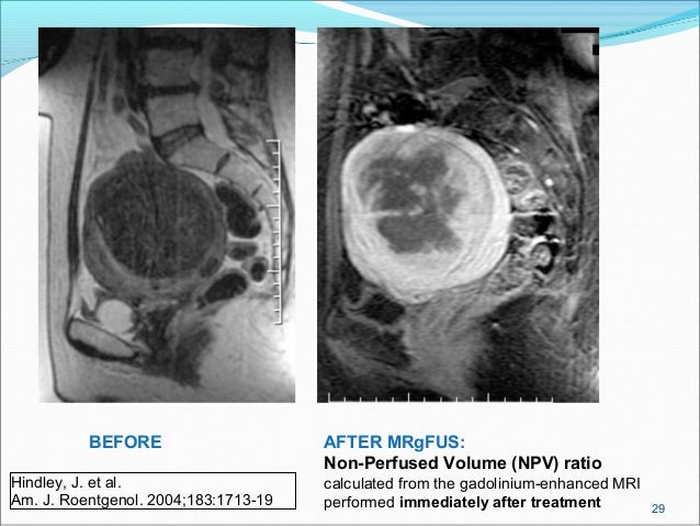 Fibroids 1230495625313464