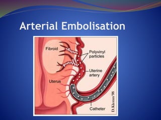 Arterial Embolisation
 