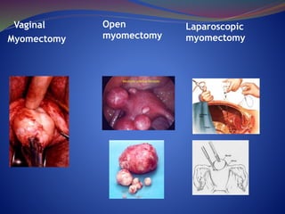 Vaginal
Myomectomy
Laparoscopic
myomectomy
Open
myomectomy
 