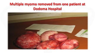 Multiple myoma removed from one patient at
Dodoma Hospital
 