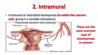 2. Intramural
• Intramural or interstitial leiomyomas lie within the uterine
wall, giving it a variable consistency
These are the
most common
type of
leiomyomata
in women
 