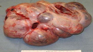 fibroids-150512150851-lva1-app6892.pptx