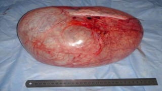 fibroids-150512150851-lva1-app6892.pptx