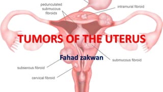 TUMORS OF THE UTERUS
Fahad zakwan
 
