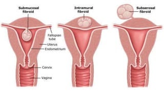 2. Intramural
• Intramural or interstitial leiomyomas lie within the uterine
wall, giving it a variable consistency
These ...