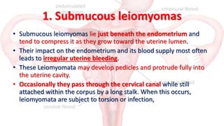 3. Subserous
• Subserous or subperitoneal leiomyomata may lie just at the
serosal surface of the uterus or may bulge outwa...