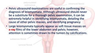 Differential Diagnosis
• Any pelvic mass, including pregnancy, may be mistaken for a
leiomyoma
1. ovarian carcinoma,
2. Ad...