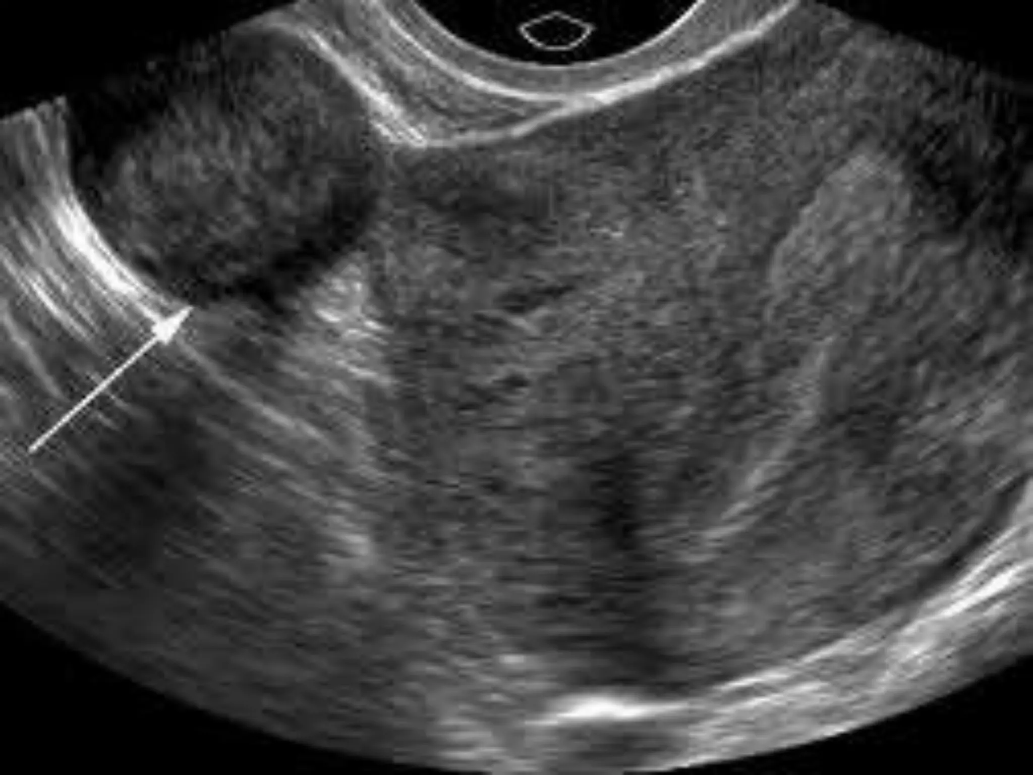Uterine Fibroids on Ultrasound | PPTX