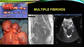MULTIPLE FIBROIDS
 