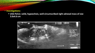 • Investigations:
 USG Pelvis: solid, hypoechoic, well-circumscribed right adnexal mass of size
3.6x4.6 cm
 