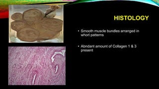 HISTOLOGY
• Smooth muscle bundles arranged in
whorl patterns
• Abndant amount of Collagen 1 & 3
present
 