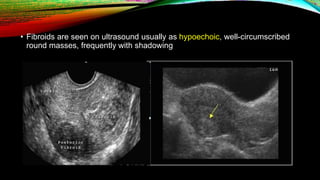 • Fibroids are seen on ultrasound usually as hypoechoic, well-circumscribed
round masses, frequently with shadowing
 