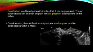 • Calcification in a fibroid generally implies that it has degenerated. These
calcifications can be seen on plain film as "popcorn" calcifications in the
pelvis.
• On ultrasound, the calcifications may appear as clumps or rim-like
calcifications within a mass
 