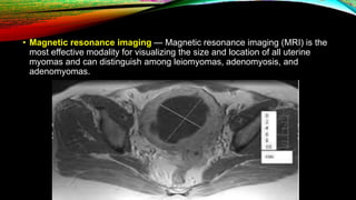 • Magnetic resonance imaging — Magnetic resonance imaging (MRI) is the
most effective modality for visualizing the size and location of all uterine
myomas and can distinguish among leiomyomas, adenomyosis, and
adenomyomas.
 
