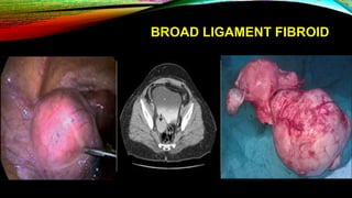 BROAD LIGAMENT FIBROID
 