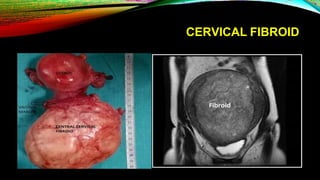 CERVICAL FIBROID
 
