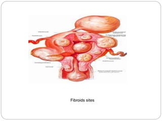 Fibroid Structure Fibroids | PPTX