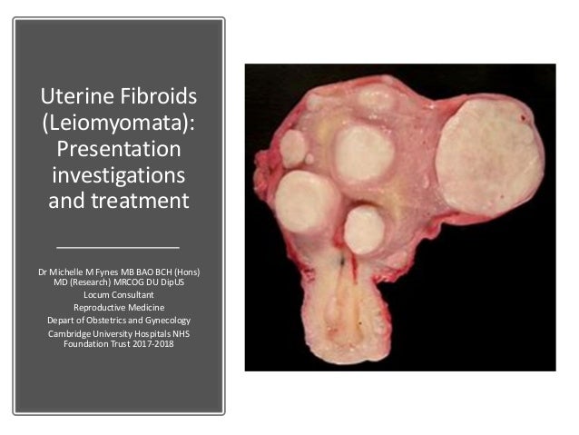 Fibroid Weight Chart