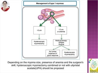 Depending on the myoma size, presence of anemia and the surgeon's
skill, hysteroscopic myomectomy combined or not with ulipristal
acetate(UPA) should be proposed
 