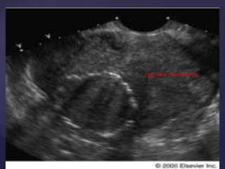 egg shell calcification 
tvs 
 