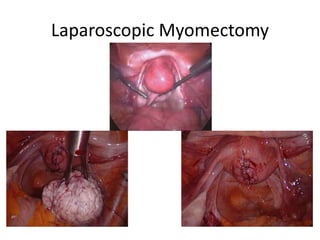Laparoscopic Myomectomy
 