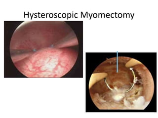 Hysteroscopic Myomectomy
 