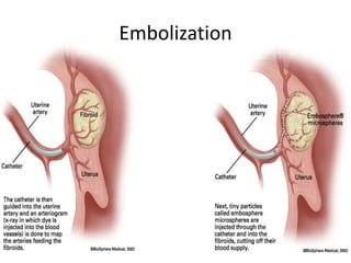 Embolization
 