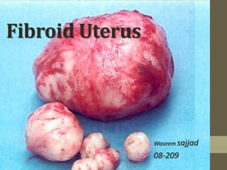 Fibroid Uterus
Waseem sajjad
08-209
 