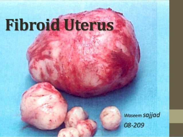 fibroid uterus by dr waseem sajjad 1 638