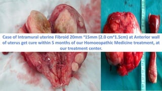 Fibroid uterus & Homoeopathy