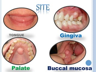 TONGUE Gingiva
Buccal mucosaPalate
 