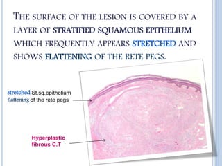 THE SURFACE OF THE LESION IS COVERED BY A
LAYER OF STRATIFIED SQUAMOUS EPITHELIUM
WHICH FREQUENTLY APPEARS STRETCHED AND
SHOWS FLATTENING OF THE RETE PEGS.
Hyperplastic
fibrous C.T
stretched St.sq.epithelium
flattening of the rete pegs
 