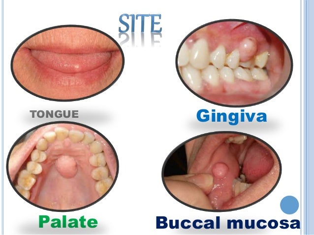 Benign Oral Tumors 32