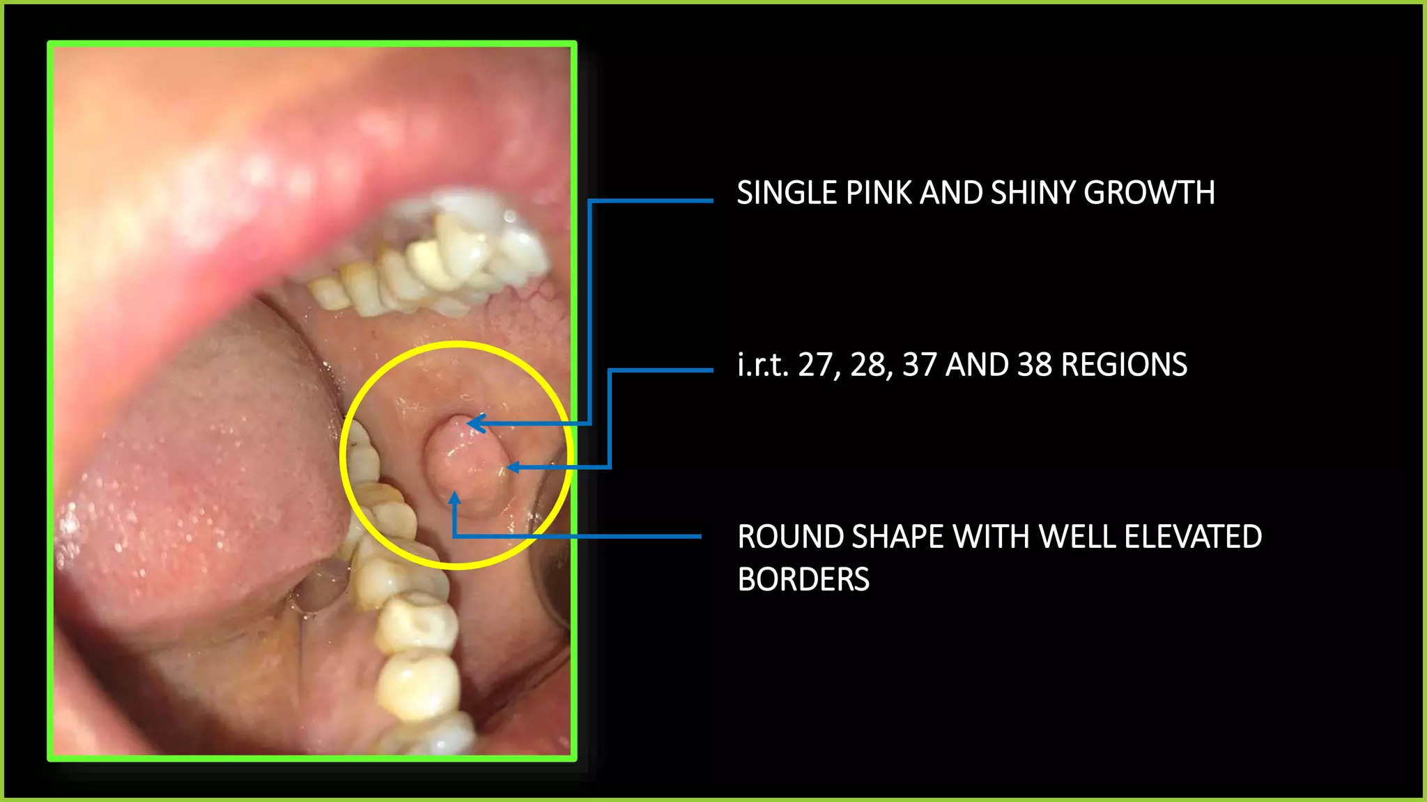 Fibroma | PPTX