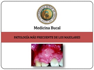 PATOLOGÍA MÁS FRECUENTE DE LOS MAXILARES
Medicina Bucal
 