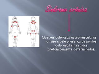 Queixas dolorosas neuromusculares
  difusa e pela presença de pontos
        dolorosos em regiões
   anatomicamente determinadas.
 