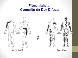 Fibromialgia
Conceito de Dor Difusa
 