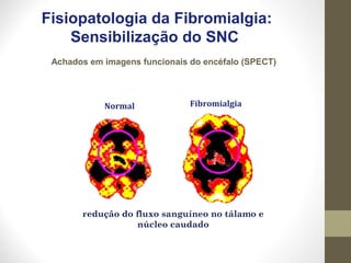 Achados em imagens funcionais do encéfalo (SPECT)
Fisiopatologia da Fibromialgia:
Sensibilização do SNC
redução do fluxo sanguíneo no tálamo e
núcleo caudado
Normal Fibromialgia
 