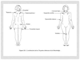 Fibromialgia