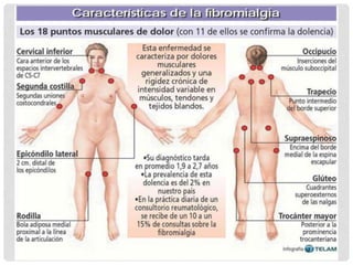 Fibromialgia