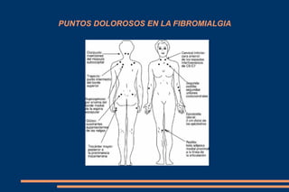 PUNTOS DOLOROSOS EN LA FIBROMIALGIA 