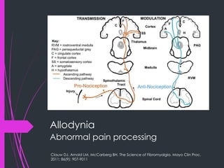 Allodynia
Abnormal pain processing
Clauw DJ, Arnold LM, McCarberg BH. The Science of Fibromyalgia. Mayo Clin Proc.
2011; 86(9): 907-9011
 